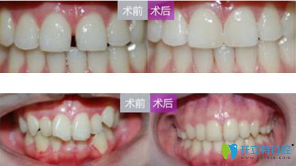 牙列稀疏+压裂拥挤、上牙前突矫正效果对比图