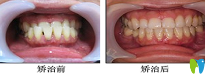 宁波拜博拜尔牙齿畸形矫正效果图