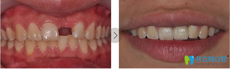 左上前牙缺失种植案例