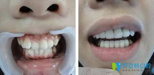 任国亨主任牙齿矫正案例 任国亨主任牙齿矫正案例