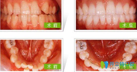 惠州致美口腔成人牙齿矫正案例前后对比图