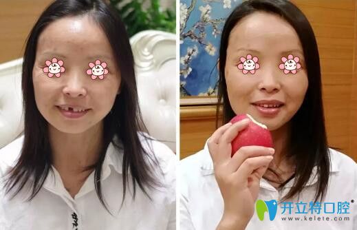 赵宝红种植牙案例 赵宝红种植牙案例