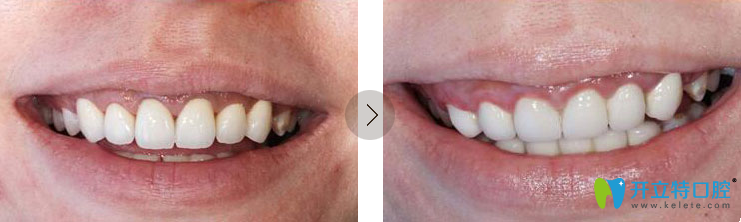 冠延长术及牙周治疗前后对比