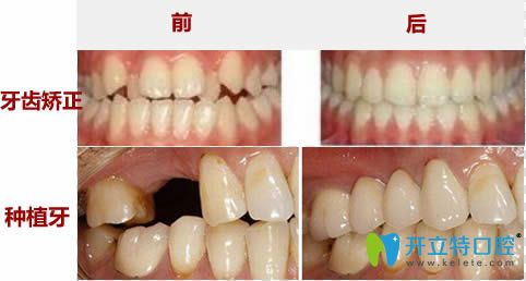 抚顺瑞德牙齿矫正和种植牙齿前后对比案例