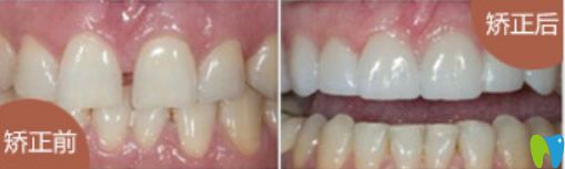 牙列稀疏、牙齿歪等矫正后效果对比图