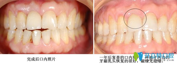 种植牙修复术后案例