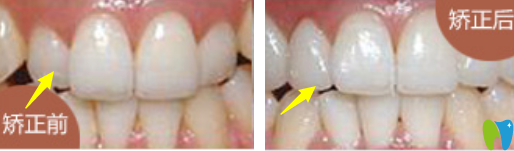 牙齿正畸效果对比图 牙齿正畸效果对比图