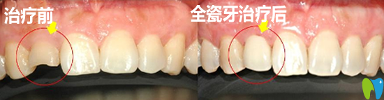 孝感口腔全瓷牙治疗效果案例