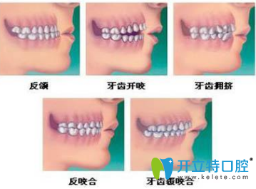 儿童矫正牙齿有哪几个年龄段？有几种矫牙齿的方法？