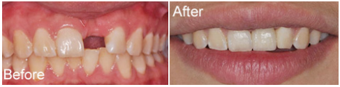 洛阳维乐口腔牙齿缺失？看洛阳维乐口腔医生做种植牙修复改善前后效果