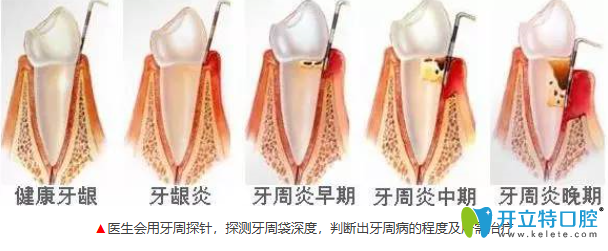 牙周疾病不同阶段