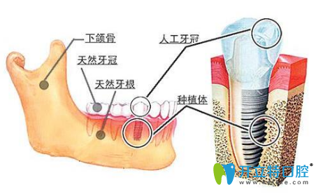 上海医保定点万众口腔解答种植牙寿命多久取决于如何护理
