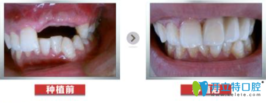 沈阳米加口腔种植牙案例
