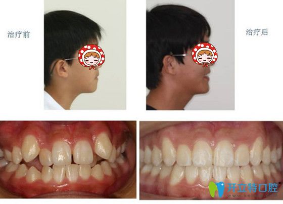 眉山开创齿科冯刚儿童牙齿矫正案例前后对比图