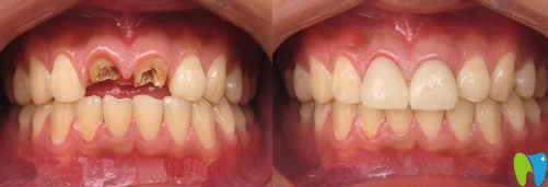 厦门宏沅膛林精宝牙齿根管治疗术前术后效果对比图