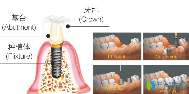 郴州芙蓉口腔牙齿种植过程