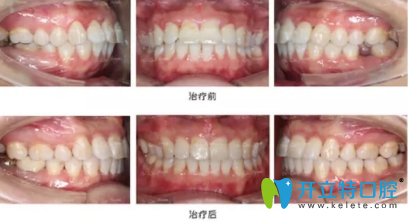完全恢复之后我简直很开心,牙齿就这么完美了 完全恢复之后我简直很开心,牙齿就这么完美了