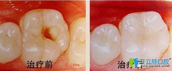 孝感口腔龋齿治疗前后效果对比图