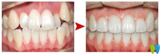 厦门宏沅膛陈少杰牙齿矫正效果对比图
