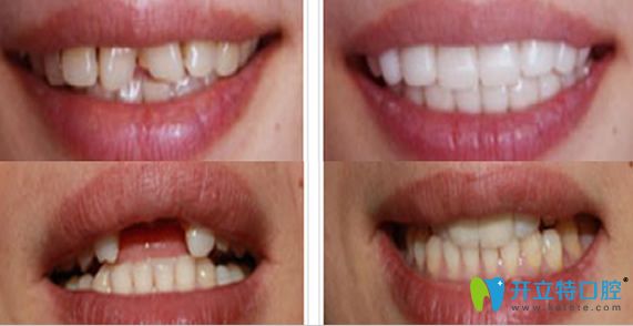 牙齿美学修复案例+牙齿种植案例