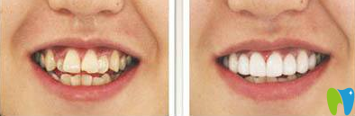 厦门宏沅膛杜海洲口腔正畸术前术后效果图