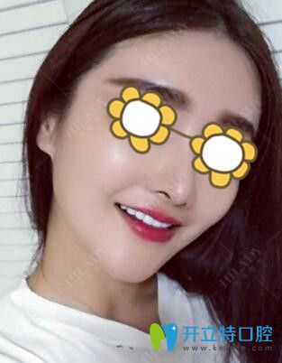 牙贴面美白一个月效果 牙贴面美白一个月效果