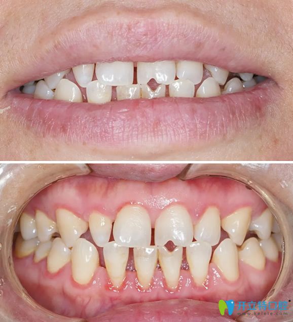 遵义华美口腔3D牙贴面前牙齿照片 遵义华美口腔3D牙贴面前牙齿照片