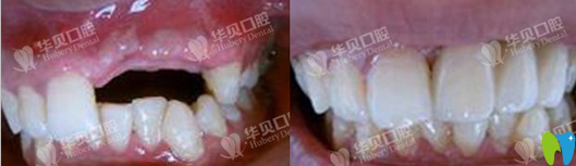 潍坊华贝口腔种植牙术前术后效果对比图