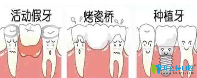 现在都是种植牙了