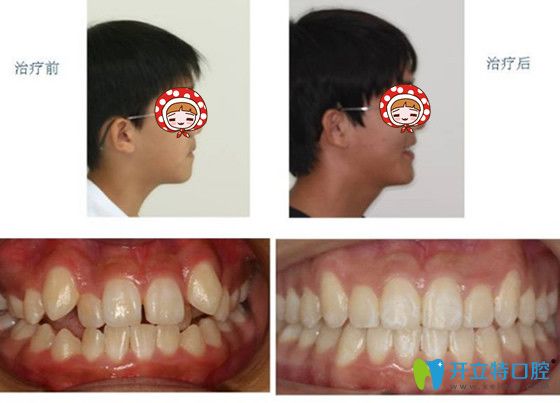 儿童牙齿矫正案例及前后对比图