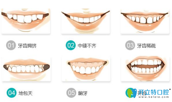 需要矫正牙齿的6种类型