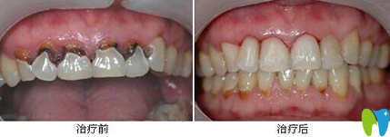 潍坊华贝口腔李黎明牙齿根管治疗术前术后对比图