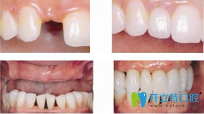 万翔口腔单颗和多颗牙种植效果案例