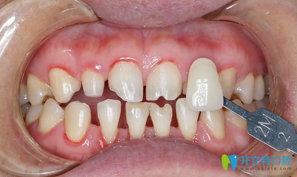 遵义华美牙齿贴面制作前基牙色比色 遵义华美牙齿贴面制作前基牙色比色