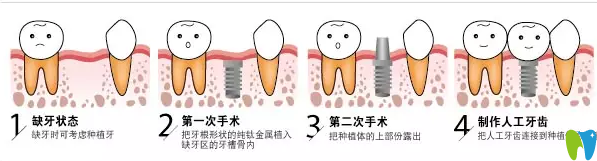 种植牙的手术方法