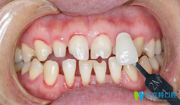 3D牙贴面制作前目标色比色 3D牙贴面制作前目标色比色