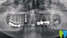 牙齿种植前拍的全景CT