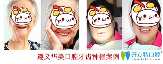 遵义华美口腔牙齿种植案例