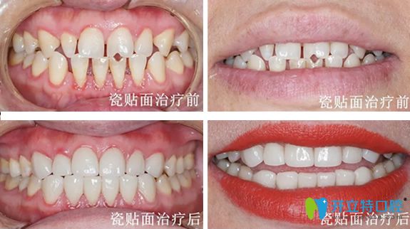 遵义华美口腔3D牙齿贴面治疗前后对比照片 遵义华美口腔3D牙齿贴面治疗前后对比照片