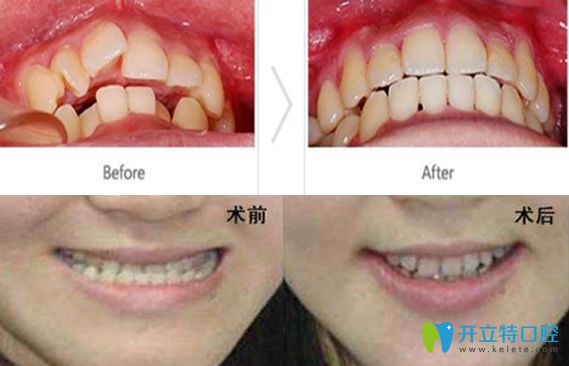 遵义华美口腔嬴胡川牙齿拥挤矫正案例+地包天矫正案例 遵义华美口腔嬴胡川牙齿拥挤矫正案例+地包天矫正案例
