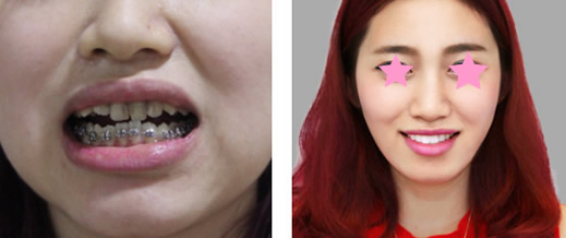 湘潭信赖口腔真人案例证明 牙齿矫正真的会改变脸型