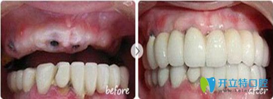 牙齿种植前后对比