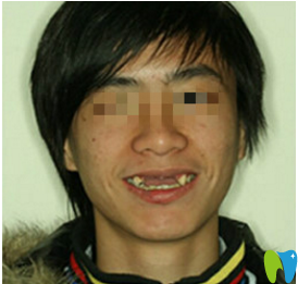 治疗前面照 治疗前面照