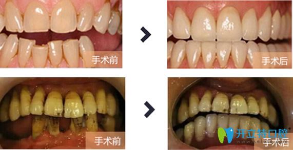 达州华美口腔种植牙好吗？看种植牙治疗前后对比案例效果显示