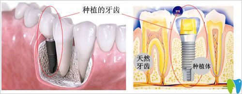 什么是种植牙