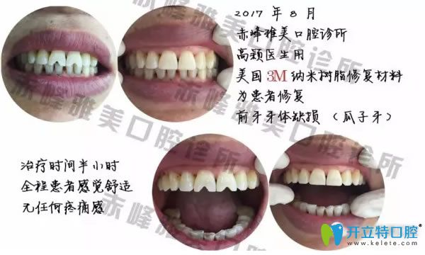 赤峰雅美口腔牙齿修复案例