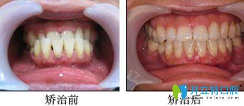 口腔正畸案例 口腔正畸案例