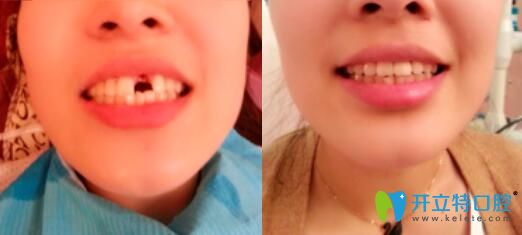 柳春柳医师牙齿种植修复案例