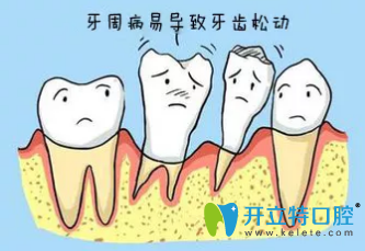 牙周病导致牙齿松动