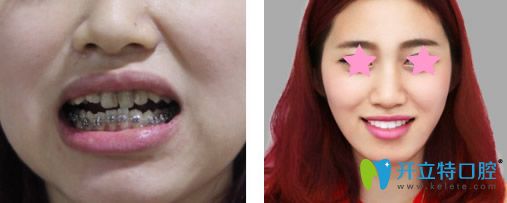 信赖口腔牙齿矫正一年后效果对比图